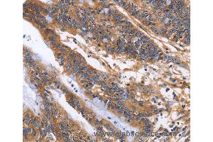 Immunohistochemistry of Human colon cancer using ITGB1 Polyclonal Antibody at dilution of 1:60 (ITGB1 抗体)