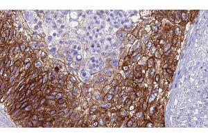 ABIN6268897 at 1/100 staining Human urothelial cancer tissue by IHC-P.