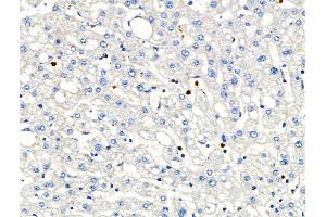 ABIN6263158 and ABIN6266586 at 1/100 staining Human liver cancer and adjacent normal tissues by IHC-P. (MCM2 抗体  (N-Term))