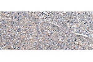 Immunohistochemistry of paraffin-embedded Human liver cancer tissue using ARL1 Polyclonal Antibody at dilution of 1:50(x200) (ARL1 抗体)