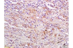 Formalin-fixed and paraffin embedded human lung carcinoma labeled Anti-DAPK2/DRP1 Polyclonal Antibody, Unconjugated (ABIN733358) at 1:200, followed by conjugation to the secondary antibody and DAB staining (Dapk1/2 (AA 271-370) 抗体)