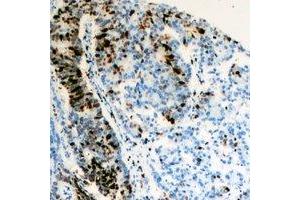 Immunohistochemical analysis of TFIIF RAP 30 staining in human colon cancer formalin fixed paraffin embedded tissue section. (GTF2F2 抗体)