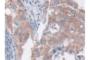 IHC-P analysis of Human Breast cancer Tissue, with DAB staining. (CCL20 抗体  (AA 27-96))
