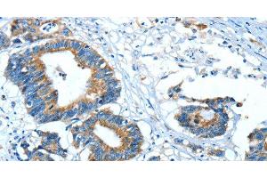 Immunohistochemistry of paraffin-embedded Human colon cancer using GLRA1 Polyclonal Antibody at dilution of 1:30 (GLRA1 抗体)