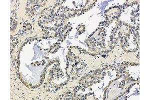 GAB3 Antibody at 1/100 staining human ovarian cancer by IHC-P.