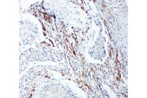 IHC-P: SHC1 antibody testing of human lung cancer tissue.