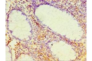 Immunohistochemistry of paraffin-embedded human colon cancer using ABIN7164384 at dilution of 1:100 (DHX58 抗体  (AA 389-678))