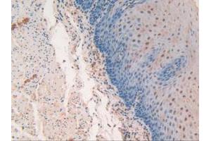 IHC-P analysis of Human Esophagus Cancer Tissue, with DAB staining. (SP100 抗体  (AA 610-802))