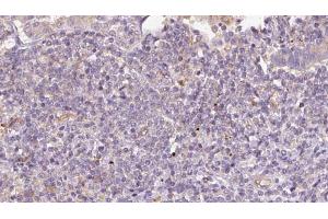 ABIN6273171 at 1/100 staining Human lymph cancer tissue by IHC-P. (STT3B 抗体  (C-Term))