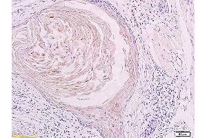 Formalin-fixed and paraffin embedded human oral squamous cell carcinoma labeled with Anti LYVE-1 Polyclonal Antibody, unconjugated (ABIN674799) at 1:200 followed by incubation with conjugated secondary antibody and DAB staining