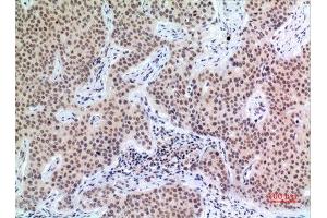 Immunohistochemistry (IHC) analysis of paraffin-embedded Human Mammary Cancer, antibody was diluted at 1:100. (P57 (Ser24) 抗体)