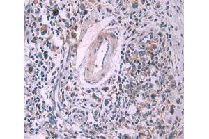 Used in DAB staining on fromalin fixed paraffin- embedded stomach cancer tissue (SFRP4 抗体  (AA 25-222))