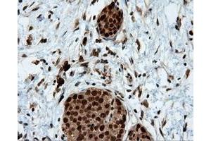 Immunohistochemical staining of paraffin-embedded Adenocarcinoma of colon tissue using anti-LTA4H mouse monoclonal antibody. (LTA4H 抗体)