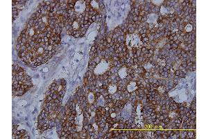 Immunoperoxidase of monoclonal antibody to FASN on formalin-fixed paraffin-embedded human breast cancer tissue. (Fatty Acid Synthase 抗体  (AA 1-439))