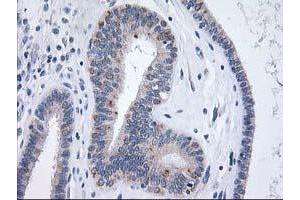 Immunohistochemical staining of paraffin-embedded Adenocarcinoma of Human endometrium tissue using anti-XPNPEP3 mouse monoclonal antibody. (XPNPEP3 抗体)