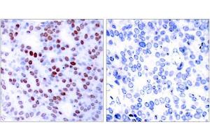 Immunohistochemical analysis of paraffin-embedded human breast carcinoma tissue, using c-Jun (epitope around residue 243) antibody (ABIN5976223). (C-JUN 抗体  (Ser243))