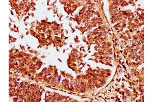 IHC image of ABIN7146274 diluted at 1:400 and staining in paraffin-embedded human cervical cancer performed on a Leica BondTM system. (CABIN1 抗体  (AA 1978-2123))