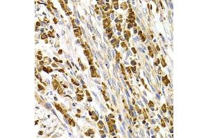 Immunohistochemistry of paraffin-embedded human stomach cancer using TACR3 antibody. (TACR3 抗体  (AA 356-465))
