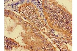 Immunohistochemistry of paraffin-embedded human endometrial cancer using ABIN7170144 at dilution of 1:100 (SLC22A2 抗体  (AA 48-135))