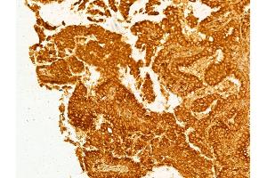 ABIN6264954 and ABIN6268714 at 1/100 staining Human lung cancer by IHC-P.
