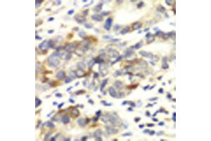 Immunohistochemistry of paraffin-embedded human colon carcinoma using APLP1 antibody at dilution of 1:100 (x40 lens). (APLP1 抗体)