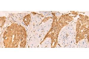 Immunohistochemistry of paraffin-embedded Human esophagus cancer tissue using SETD1A Polyclonal Antibody at dilution of 1:25(x200) (SETD1A 抗体)