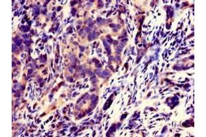 Immunohistochemistry of paraffin-embedded human pancreatic cancer using ABIN7170444 at dilution of 1:100 (C21ORF56 抗体  (AA 1-186))