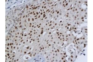 Formalin-fixed and paraffin embedded human bladder cancer labeled with Anti-DBC1/DELETED IN BLADDER CANCER 1 Polyclonal Antibody, Unconjugated (ABIN680308) followed by conjugation to the secondary antibody and DAB staining (DBC1 抗体  (AA 101-200))
