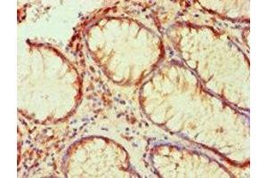 Immunohistochemical of paraffin-embedded human colon cancer using ABIN7176818 at dilution of 1:200. (PLA2G7 抗体)