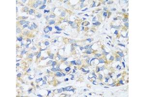Immunohistochemistry of paraffin-embedded Human breast cancer using BRK1 Polyclonal Antibody at dilution of 1:100 (40x lens).