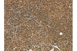 The image on the left is immunohistochemistry of paraffin-embedded Human ovarian cancer tissue using ABIN7192784(TGM7 Antibody) at dilution 1/30, on the right is treated with synthetic peptide. (Transglutaminase 7 抗体)