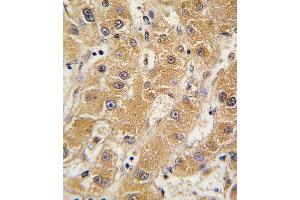 Formalin-fixed and paraffin-embedded human hepatocarcinoma tissue reacted with OA5 antibody (N-term) 7412a , which was peroxidase-conjugated to the secondary antibody, followed by DAB staining. (APOA5 抗体  (N-Term))