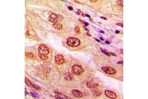 Immunohistochemical analysis of CaMK4 staining in human lung cancer formalin fixed paraffin embedded tissue section. (CAMK4 抗体)