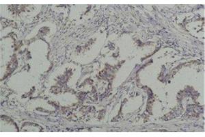 Immunohistochemistry of paraffin-embedded Human breast carcinoma tissue with Phosphotyrosine Monoclonal Antibody at dilution of 1:200 (Phosphotyrosine 抗体)