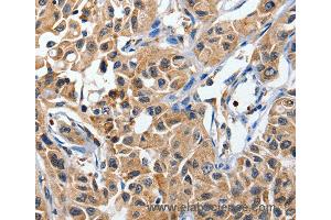 Immunohistochemistry of Human lung cancer using DUSP8 Polyclonal Antibody at dilution of 1:40 (DUSP8 抗体)