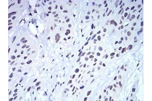 Immunohistochemical analysis of paraffin-embedded esophageal cancer tissues using CBX5 mouse mAb with DAB staining. (CBX5 抗体  (AA 1-191))