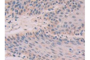 DAB staining on IHC-P; Samples: Human Stomach cancer Tissue (IL-33 抗体  (AA 1-270))