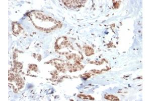 Formalin-fixed, paraffin-embedded human Breast Carcinoma stained with SOX4 Mouse Monoclonal Antibody (SOX4/2540). (SOX4 抗体)
