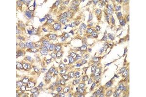 Immunohistochemistry of paraffin-embedded Human esophageal cancer using VTI1B Polyclonal Antibody at dilution of 1:100 (40x lens).