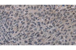 Immunohistochemistry of paraffin-embedded Human lung cancer tissue using TP53AIP1 Polyclonal Antibody at dilution 1:50 (TP53AIP1 抗体)