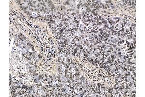 ABIN7096400 and ABIN7100464 at 1/100 staining human lung cancer by IHC-P. (PRAM1 抗体)