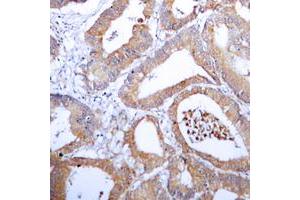 Immunohistochemical analysis of Aldose Reductase staining in human colon cancer formalin fixed paraffin embedded tissue section. (AKR1B1 抗体  (C-Term))