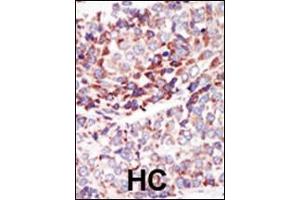 Formalin-fixed and paraffin-embedded human cancer tissue reacted with the primary antibody, which was peroxidase-conjugated to the secondary antibody, followed by AEC staining. (TEK 抗体  (C-Term))