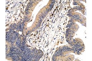 ABIN7094682 and ABIN7098733 at 1/100 staining Human colorectal cancer by IHC-P. (DMBT1 抗体  (C-Term))