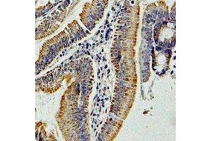 Immunohistochemical analysis of GNAI3 staining in human colon cancer formalin fixed paraffin embedded tissue section. (GNAI3 抗体)