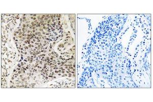 Immunohistochemistry analysis of paraffin-embedded human lung carcinoma tissue, using TSEN54 antibody. (TSEN54 抗体  (Internal Region))