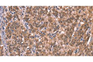 Immunohistochemistry of paraffin-embedded Human gasrtic cancer tissue using GCSAM Polyclonal Antibody at dilution 1:40 (GCET2 抗体)