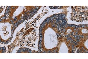 Immunohistochemistry of paraffin-embedded Human colon cancer tissue using MT-ND6 Polyclonal Antibody at dilution 1:40 (MT-ND6 抗体)