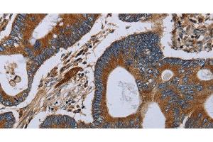 Immunohistochemistry of paraffin-embedded Human colon cancer tissue using MT-ND6 Polyclonal Antibody at dilution 1:40