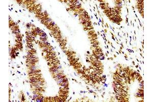 IHC image of ABIN7127295 diluted at 1:100 and staining in paraffin-embedded human colon cancer performed on a Leica BondTM system. (Recombinant HIST1H3A 抗体)
